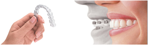 ortodoncija, ortodont, Fiksni aparatić za zube, Mobilni aparatić za zube, Safirni fiksni aparatić za zube