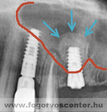 pozidanje sinusa, augmentacija, gingivoplastika, impaktiranih (neizraslih) i retiniranih umnjaka 