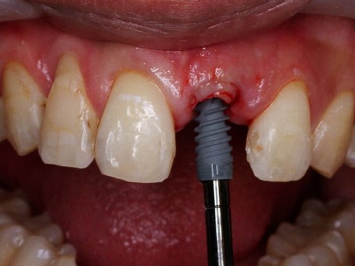 pretprotetska kirurgija, sinus lift, vadenje zuba, extrakcija umnjaka, kortikotomija, nivelacija, pozidanje sinusa, augmentacija, gingivoplastika, impaktiranih (neizraslih) i retiniranih umnjaka 