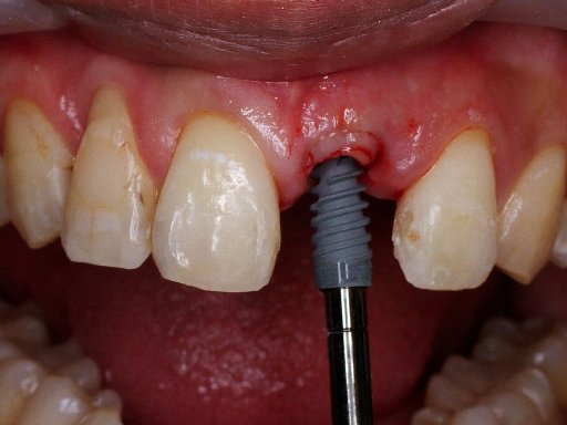 pretprotetska kirurgija, sinus lift, vadenje zuba, extrakcija umnjaka, kortikotomija, nivelacija, pozidanje sinusa, augmentacija, gingivoplastika, impaktiranih (neizraslih) i retiniranih umnjaka 