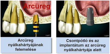 csontpótlás pécs, csontpótló anyagok, csontpótlás altatásban, bio oss, bio guide, sinus emelés, arcüreg emelés pécs, sinuslift, sinus lift, arcüreg