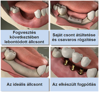 csontpótlás pécs, csontpótló anyagok, csontpótlás altatásban, csonthiány pécs, csontátültetés, csontblokk, csontforgács pécs, csontreszelék, műcsont pécs