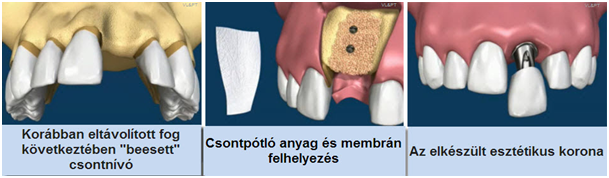 oralna kirurgija pecuh, oralna kirurgija madarska, augmentacija kosti