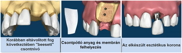 csontpótlás pécs, csontpótló anyagok, csontpótlás altatásban, csonthiány pécs, csontátültetés, csontblokk, csontforgács pécs, csontreszelék, műcsont pécs