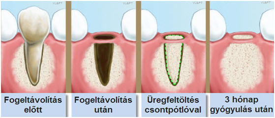 augmentacija, Bio-oss, geistlich, oralna kirurgija pecuh, madarska