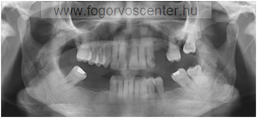 gingivitis, parodontitis, kamenca, zubnog kamenca, Čišćenje zubnog kamenca i poliranje, virovitica, osijek, pecuh, beli manastir, siklos, mohacs