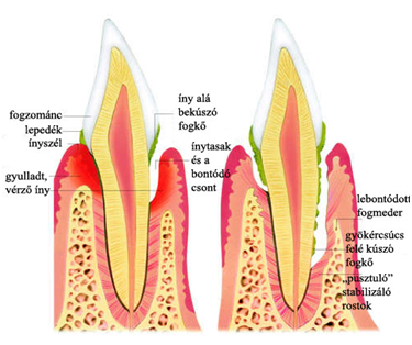 gingivitis, parodontitis, kamenca, zubnog kamenca, Čišćenje zubnog kamenca i poliranje