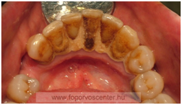 gingivitis, parodontitis, gingivits, kamenca, zubnog kamenca, mohac, pecuh, siklos, harkany, vinkovci