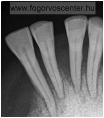 gingivitis, parodontitis, kamenca, zubnog kamenca