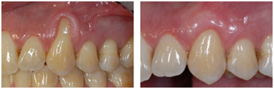 gingivoplastika, oralna kirurgija, sinus lift, kollagen membrana