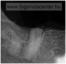 letört fog pécs, letörött fog pécs, törött fog pécs, kettétört fog, benntmaradt foggyökér, foggyökér, fog gyökér, fogeltávolítás