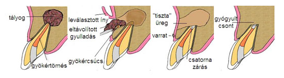 apikotomija, augmentacija, gingivoplastika, impaktiranih (neizraslih) i retiniranih umnjaka 