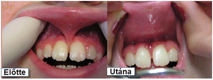 oralna kirurgija, frenulektomija, sinus lift