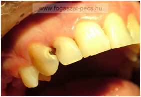 fogfájás csillapítása otthon, lyukas fog pécs, szuvas fog pécs, fogszuvasodás kezelése, hidegre érzékeny fog