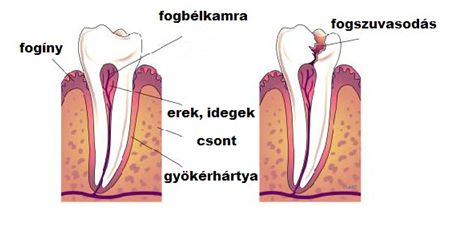 fogfájás, fogfájás okai, fogszuvasodás, szuvas fog, fogfájás csillapító, fogfájás csillapítás, lyukas fog, fájó fog