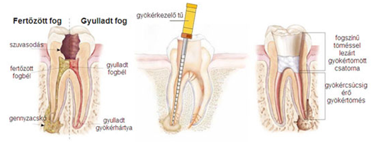 gyökérkezelés pécs, fog gyökérkezelés, kiidegelés, endodoncia, gyökérkezelés utáni fájdalom, gyökérkezelés ára, gyökérkezelés menete, endodontus pécs