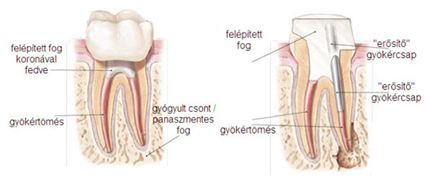 endoncia pécs, fog gyökérkezelés, kiidegelés, gyökérkezelés fájdalom, gyökérkezelés utáni fájdalom, gyökérkezelés árai, endodontus, gyökértömés