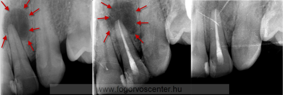 Rosszul záró, régi tömés miatt elhalt felső kismetsző és következményes tályogképződés gyökérkezelés előtt (balra), közvetlenül gyökértömés után (középen) és 3 hónappal később gyógyultan (jobbra)