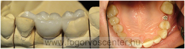 fémkerámia fogpótlás pécs, kerámia fog pécs, cirkon korona ára pécs, cirkon árak, cirkónium korona, cirkónium pécs, cirkónium fog pécs, cirkónium oxid híd