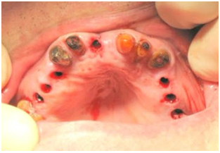 fogbeültetés fájdalom nélkül pécs, implantáció beültetés fájdalom nélkül pécs