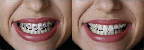ortodont osijek, ortodoncija madarska, ortodoncija pecuh, bravice, ortodoncija vinkovci, ortodoncija vukovar, ortodont